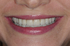 Smile_after4