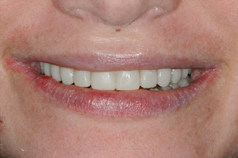Smile_after6