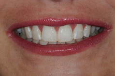 smile_after3