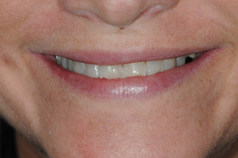 smile_before6
