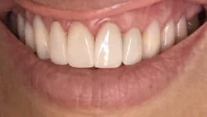 veneers - after
