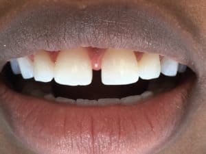 Diastema - before