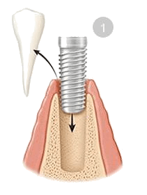 dental implants miami