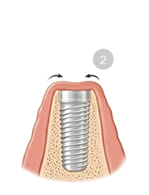 dental implants 2